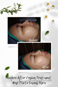Before After Pasca Treatment Zap Photo Facial Glow